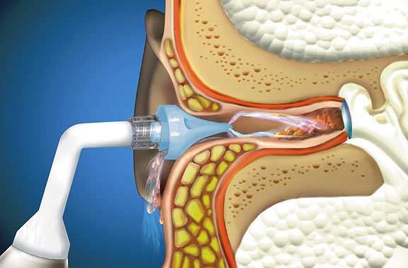 Microsuction ear wax removal service