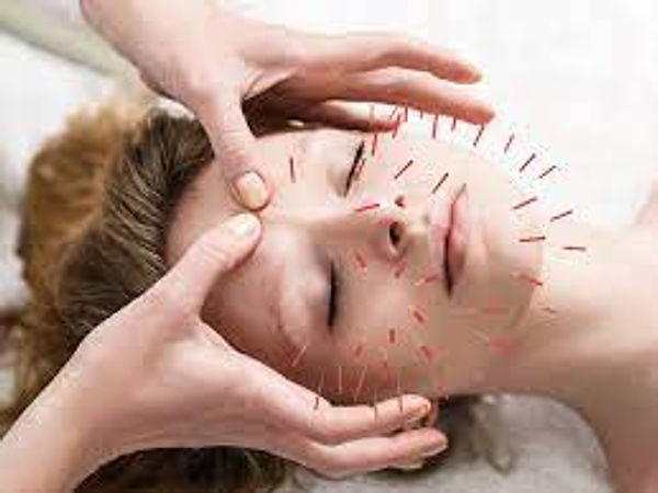 Facial enhancement acupuncture therapy at Acu Room