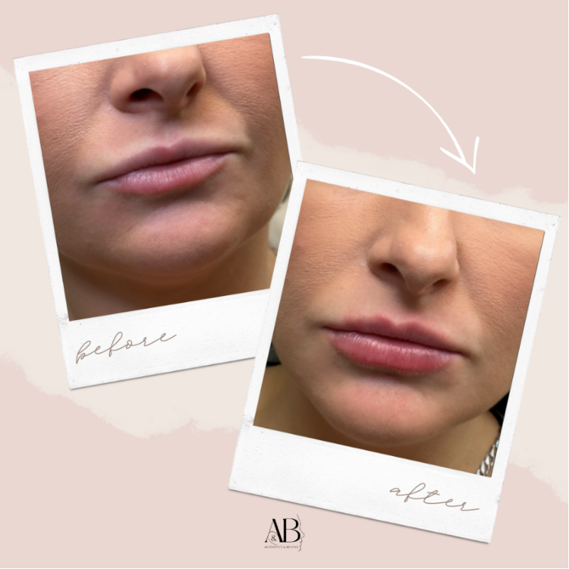 Before-and-after lip filler result, branded 'AB' (Aesthetics & Beyond)
