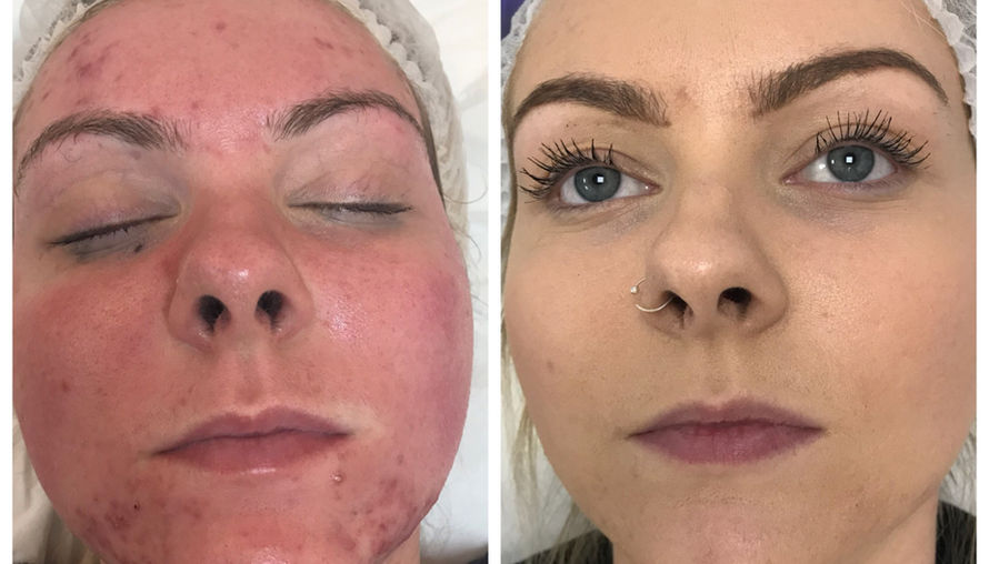 Chemical peel treatment and microneedling series results