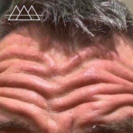 Anti-wrinkle treatment example