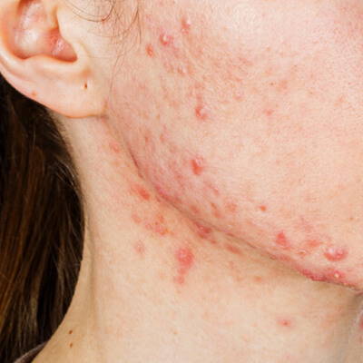 Skin concerns and treatments at Ashling Donnelly Aesthetic Clinic