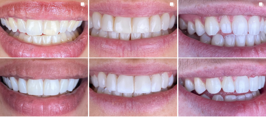 Composite bonding before-and-after results montage