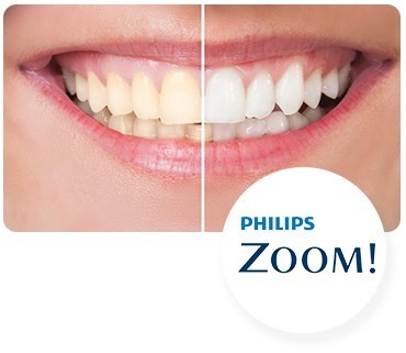 Philips Zoom teeth whitening before-and-after