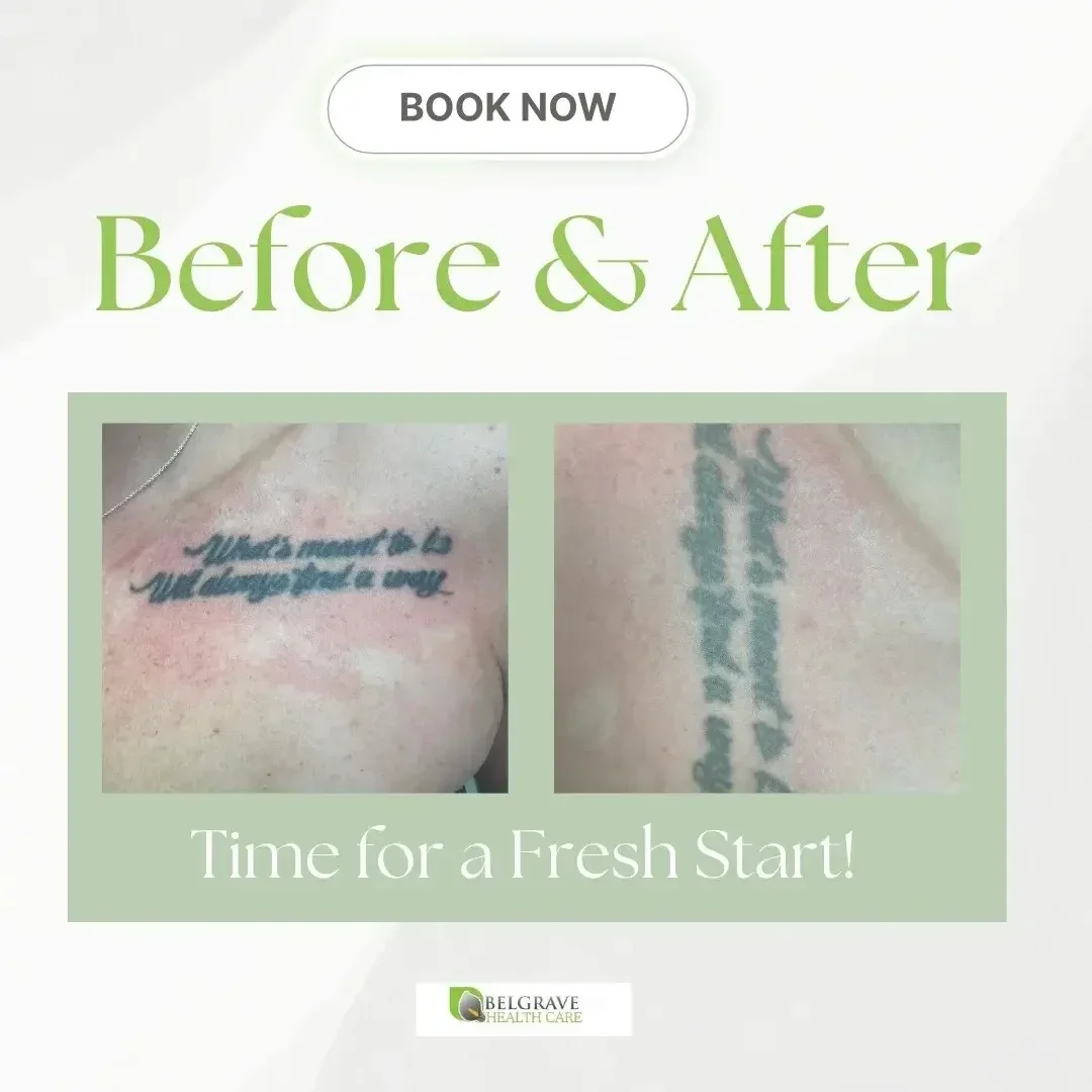 Laser tattoo removal service image