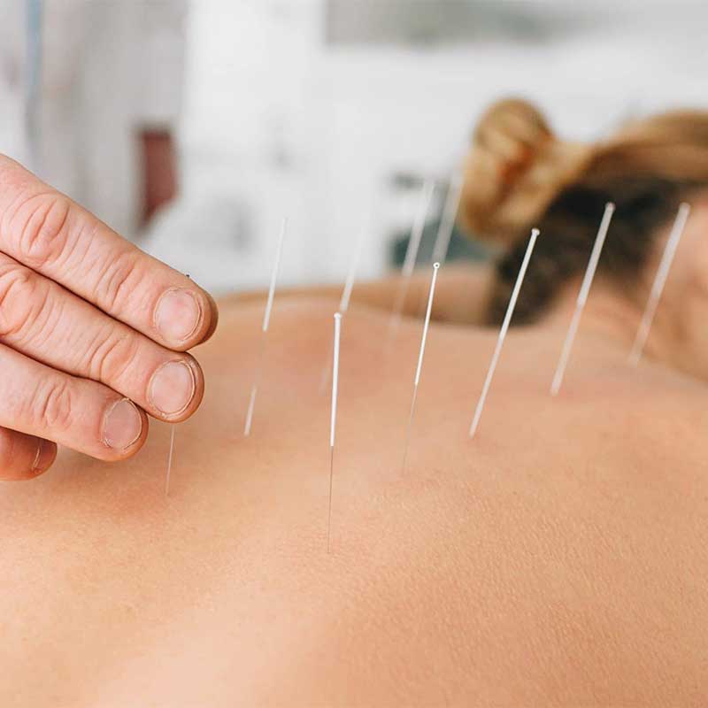 Acupuncture treatment