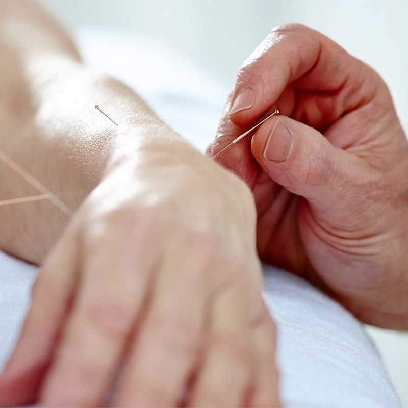 Acupuncture needles being applied