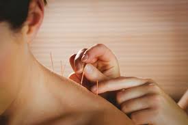 Dry needling / medical acupuncture treatment