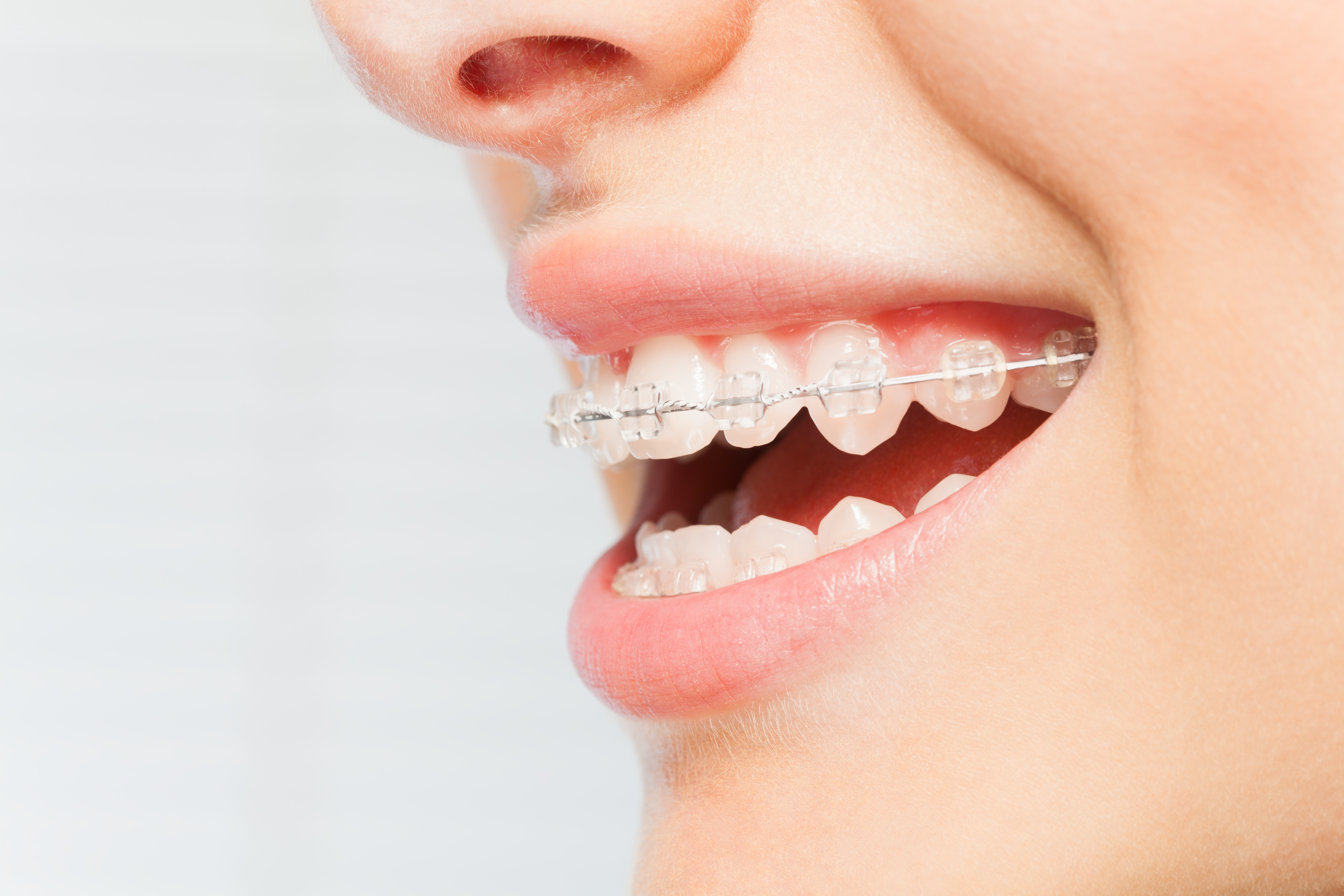 Braces smile