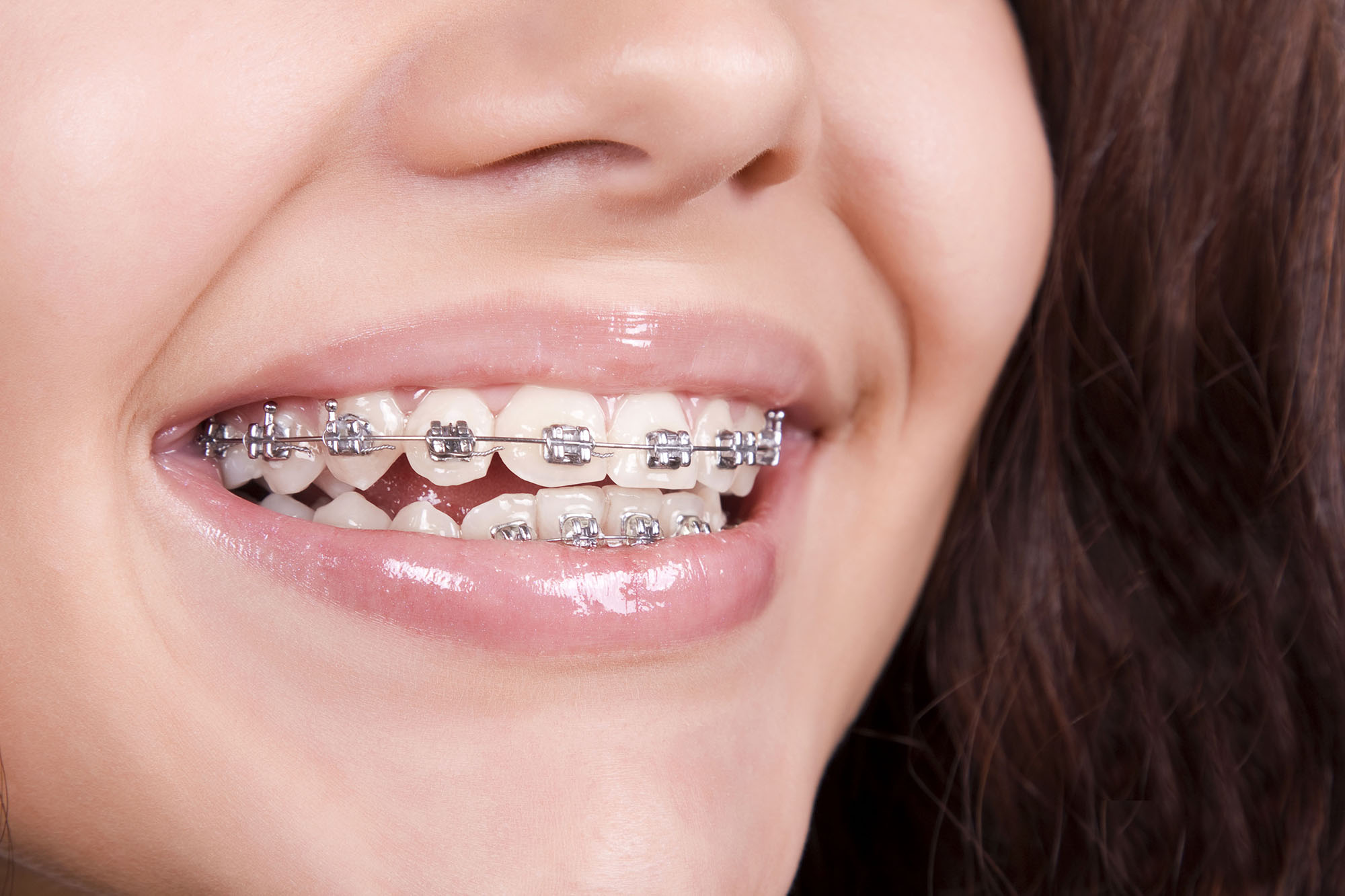 Metal fixed dental braces