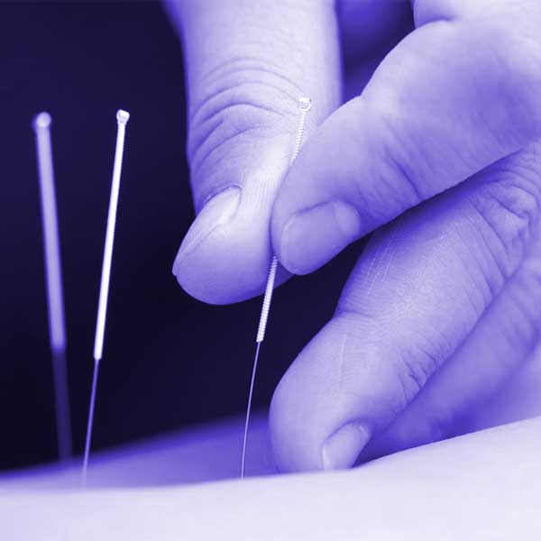 Acupuncture therapy at Cotham Chiropractic Clinic