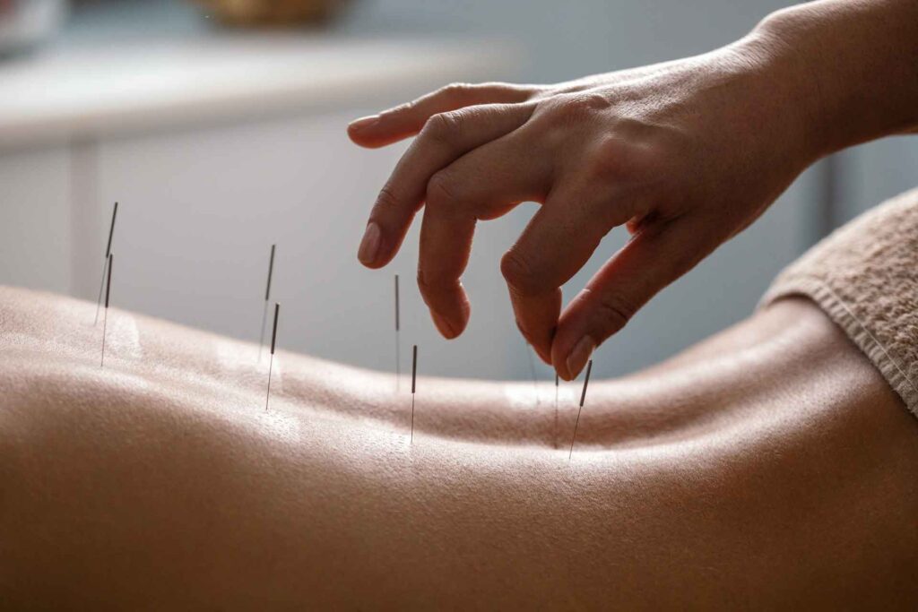 Acupuncture therapy at Davies and Coffey Osteopathy