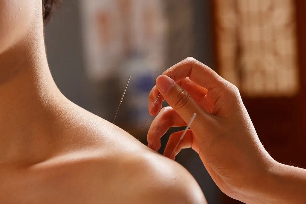 Acupuncture needle being inserted at the shoulder