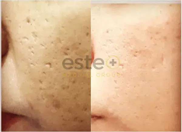 Chemical peel treatment (Open Graph share image)