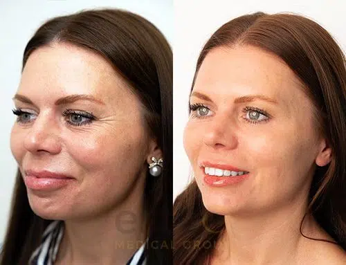 Anti-ageing treatment