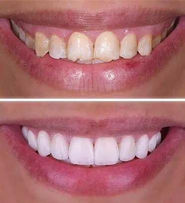 Dental treatments