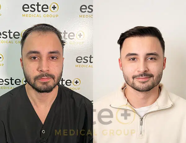 Hair transplant treatment