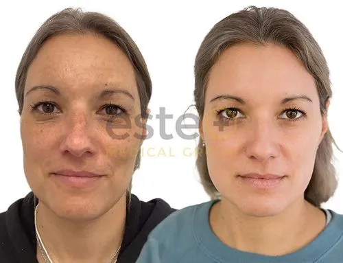 Skin pigmentation treatment