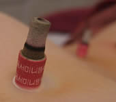 Burning moxa herb (moxibustion)