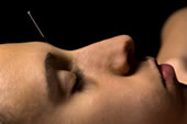 Yin Tang acupuncture point being needled to induce relaxation