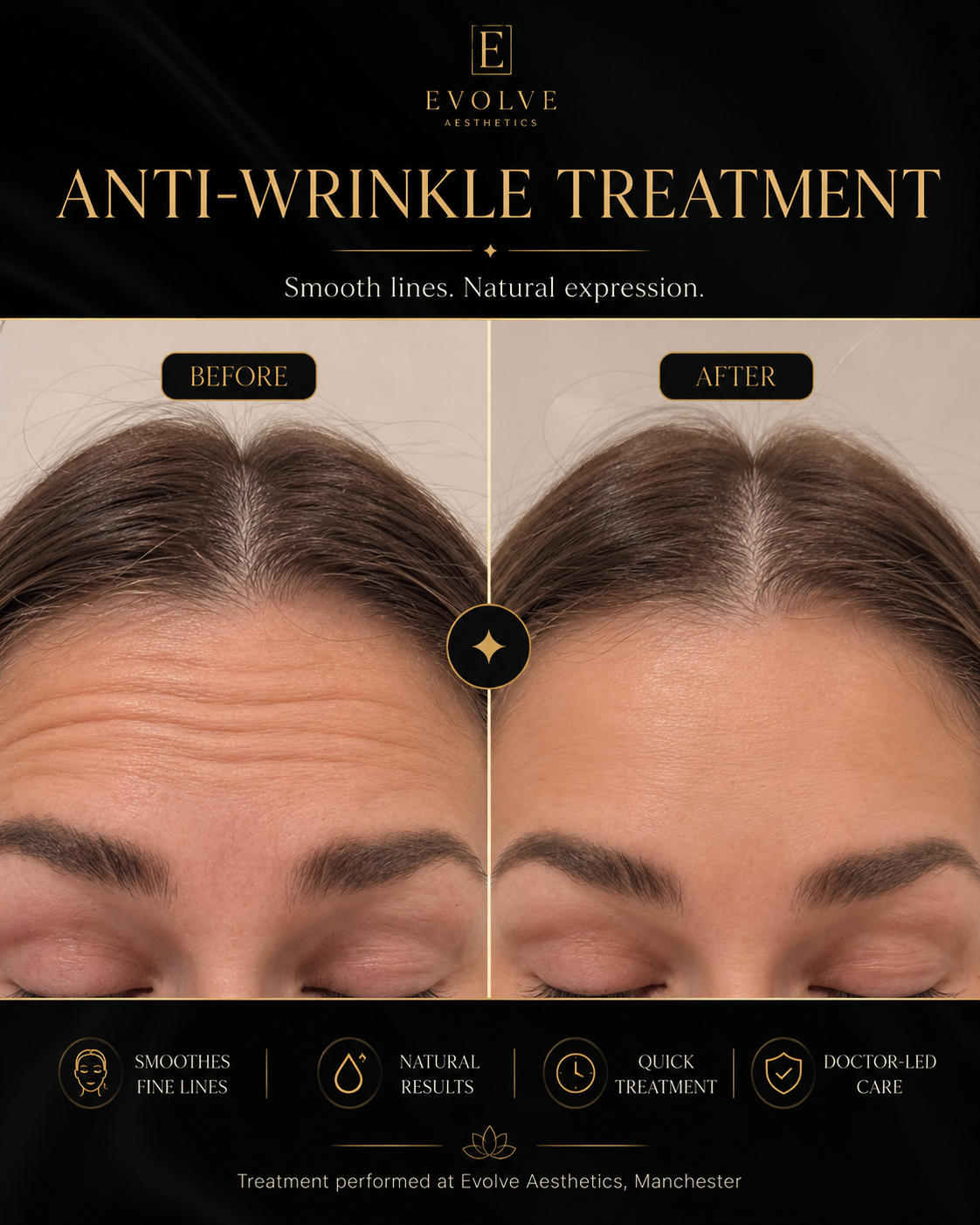 Before and after anti-wrinkle treatment results