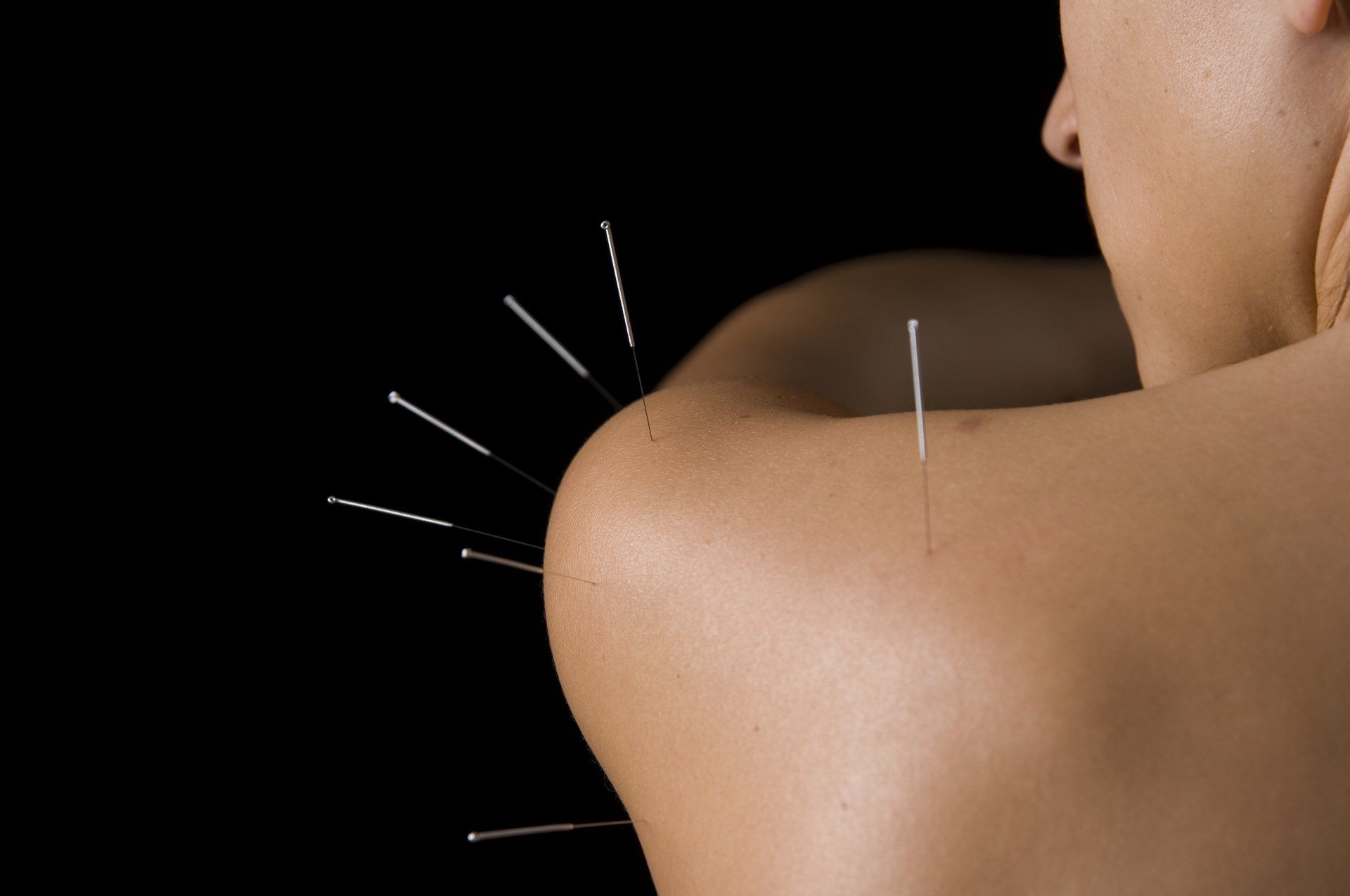 Acupuncture treatment and therapy session at Garforth clinic