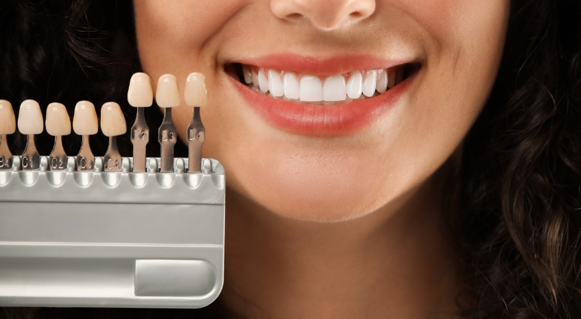 Veneers treatment