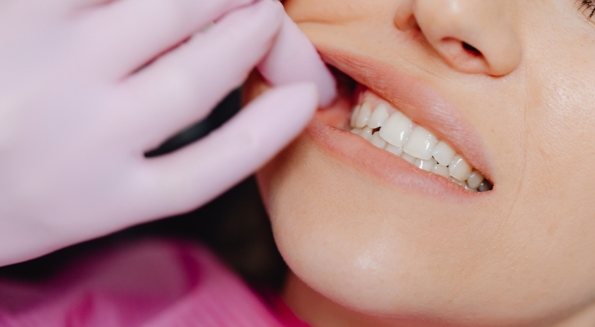 Teeth whitening treatment