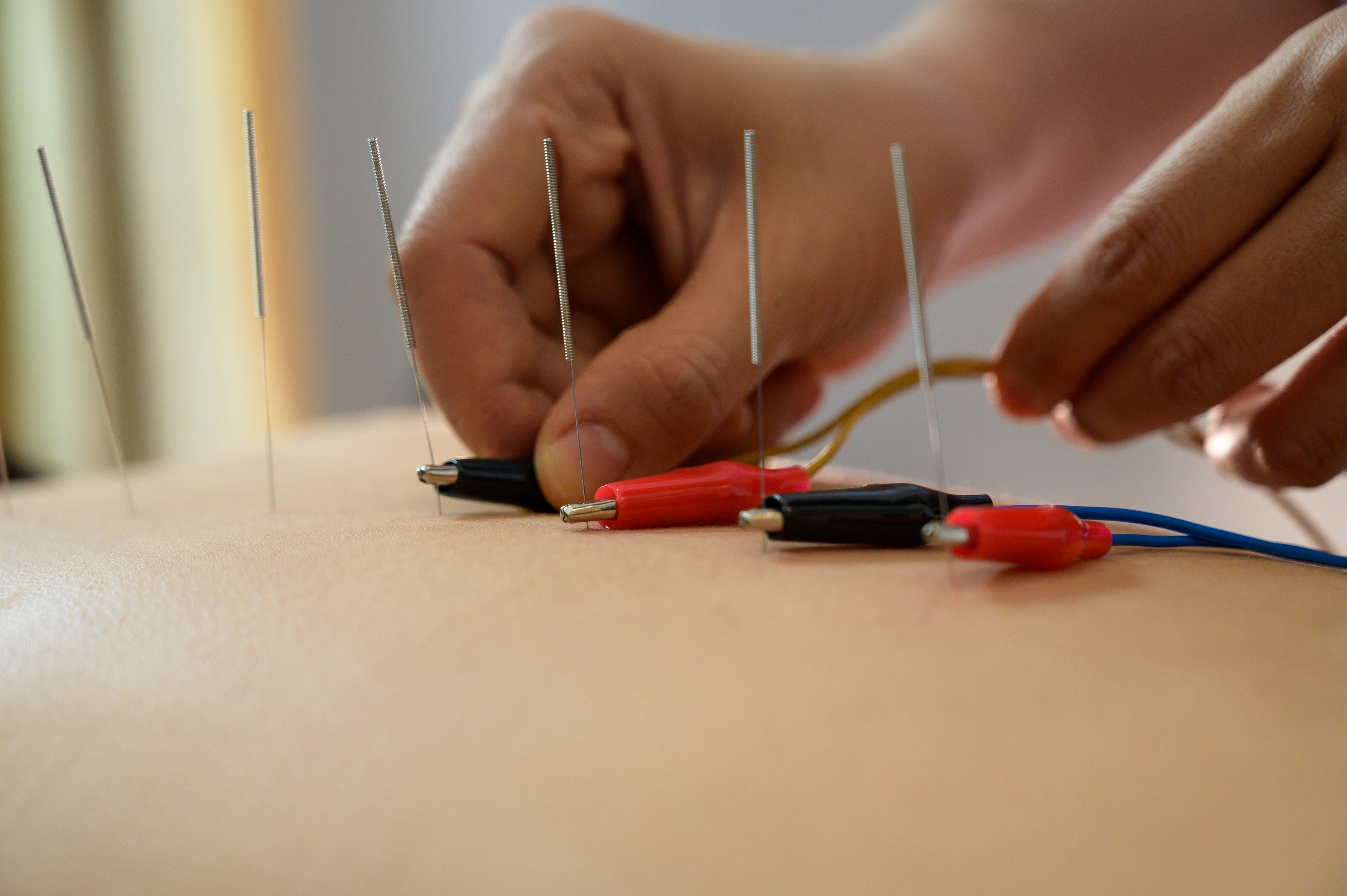 Electro Acupuncture Treatment