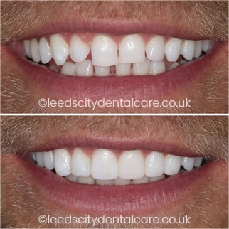 Leeds City Dentalcare smile gallery case example