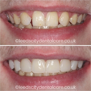 Leeds City Dentalcare smile gallery case example
