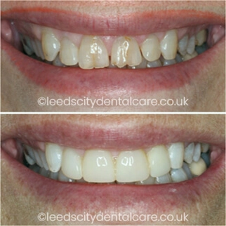 Leeds City Dentalcare smile gallery case example
