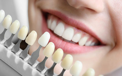 Dental implants