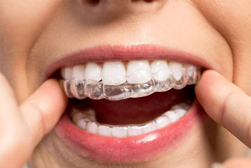 Invisalign clear aligners