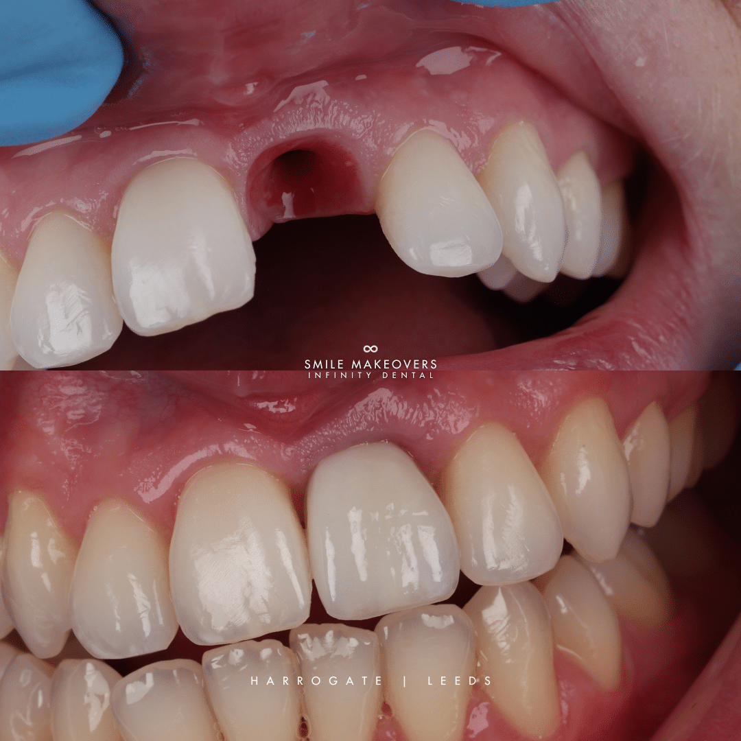 Dental implants before and after case examples