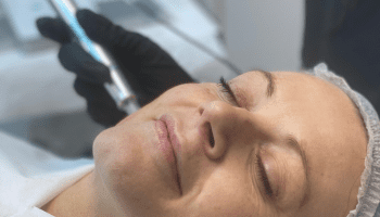 Dermal microneedling treatment image