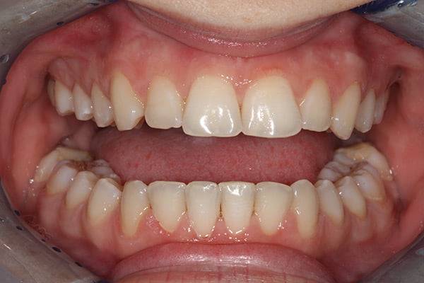 Clear aligner case, after