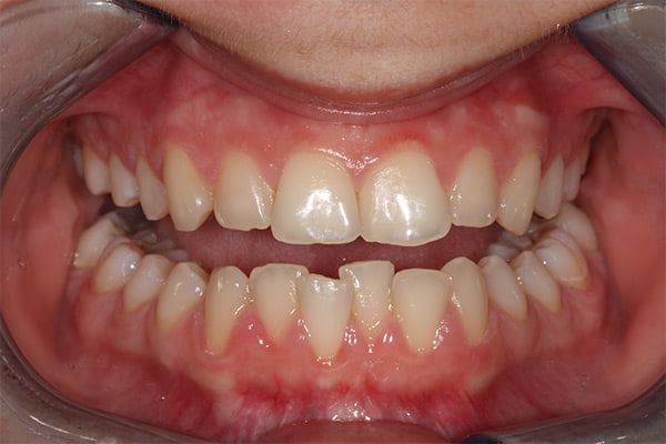 Clear aligner case, before