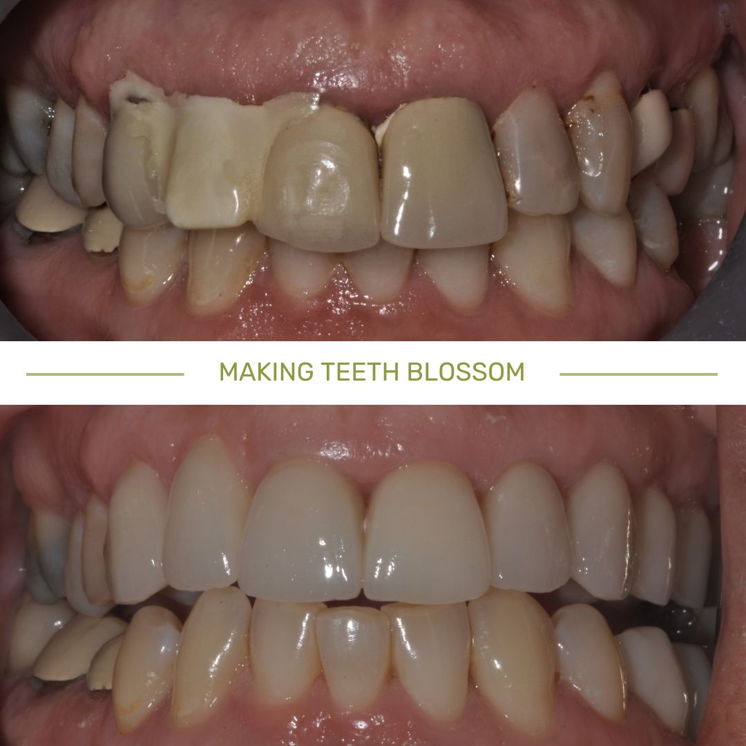 Dental implant treatment case