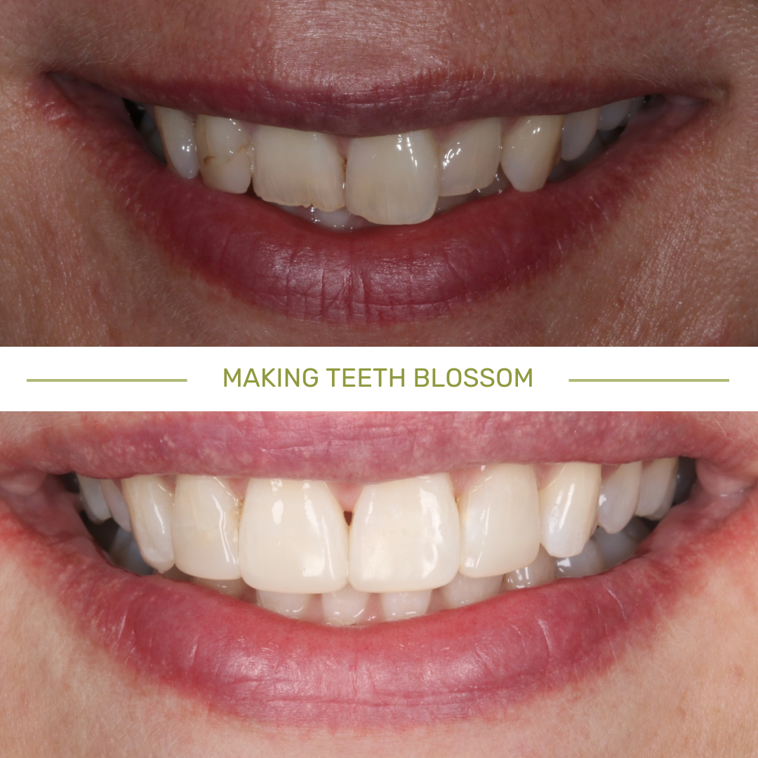 Orthodontics / teeth straightening case