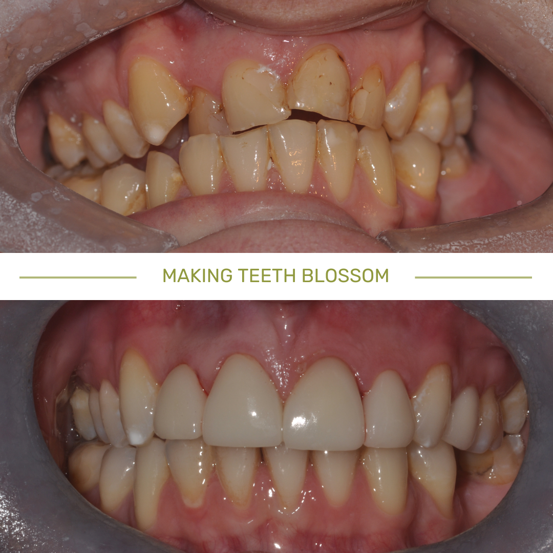 Smile design before/after case