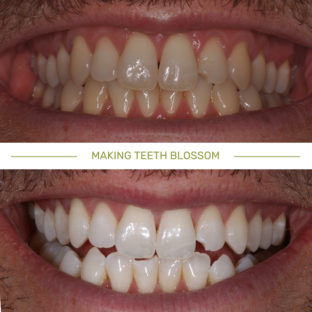 Teeth whitening before/after case