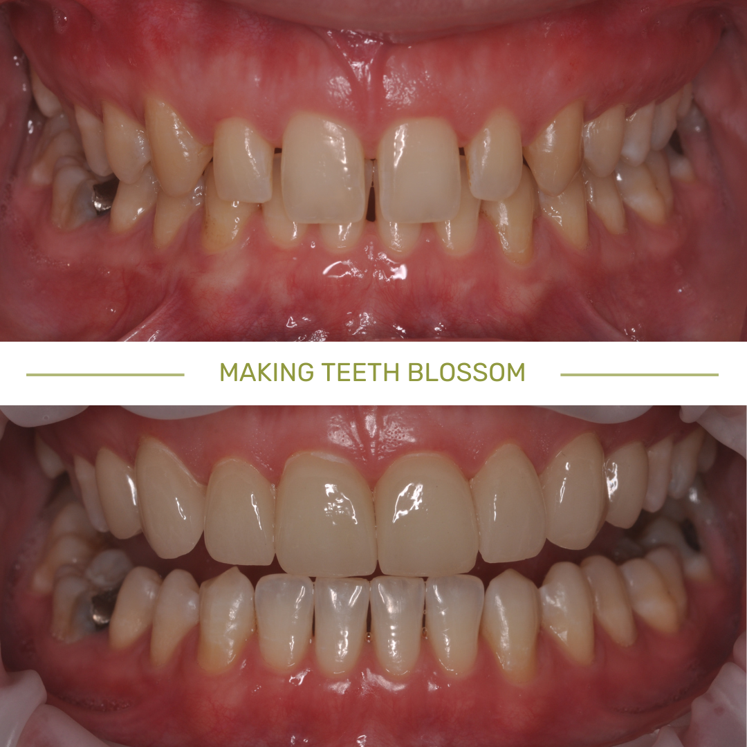 Porcelain veneers before/after case