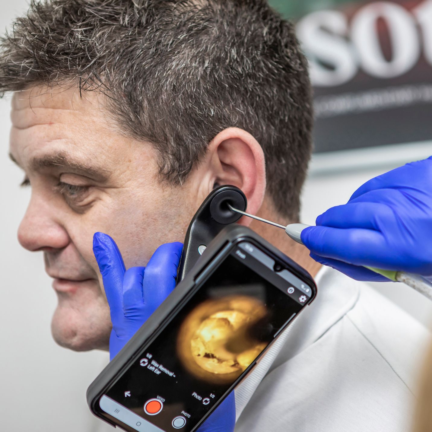 Ear wax removal using a Tympa device