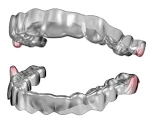 Smartee clear aligners