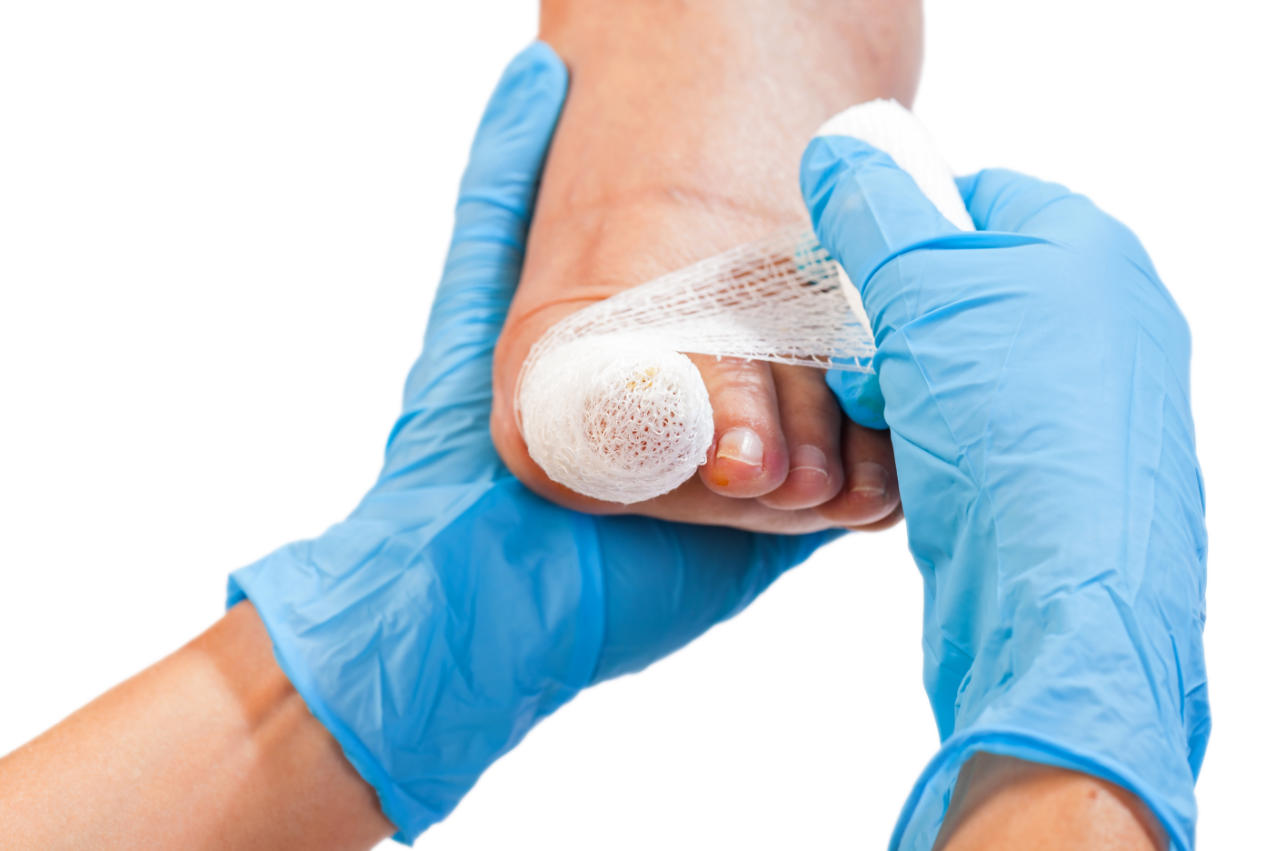 Bandaged toe after nail surgery / treatment