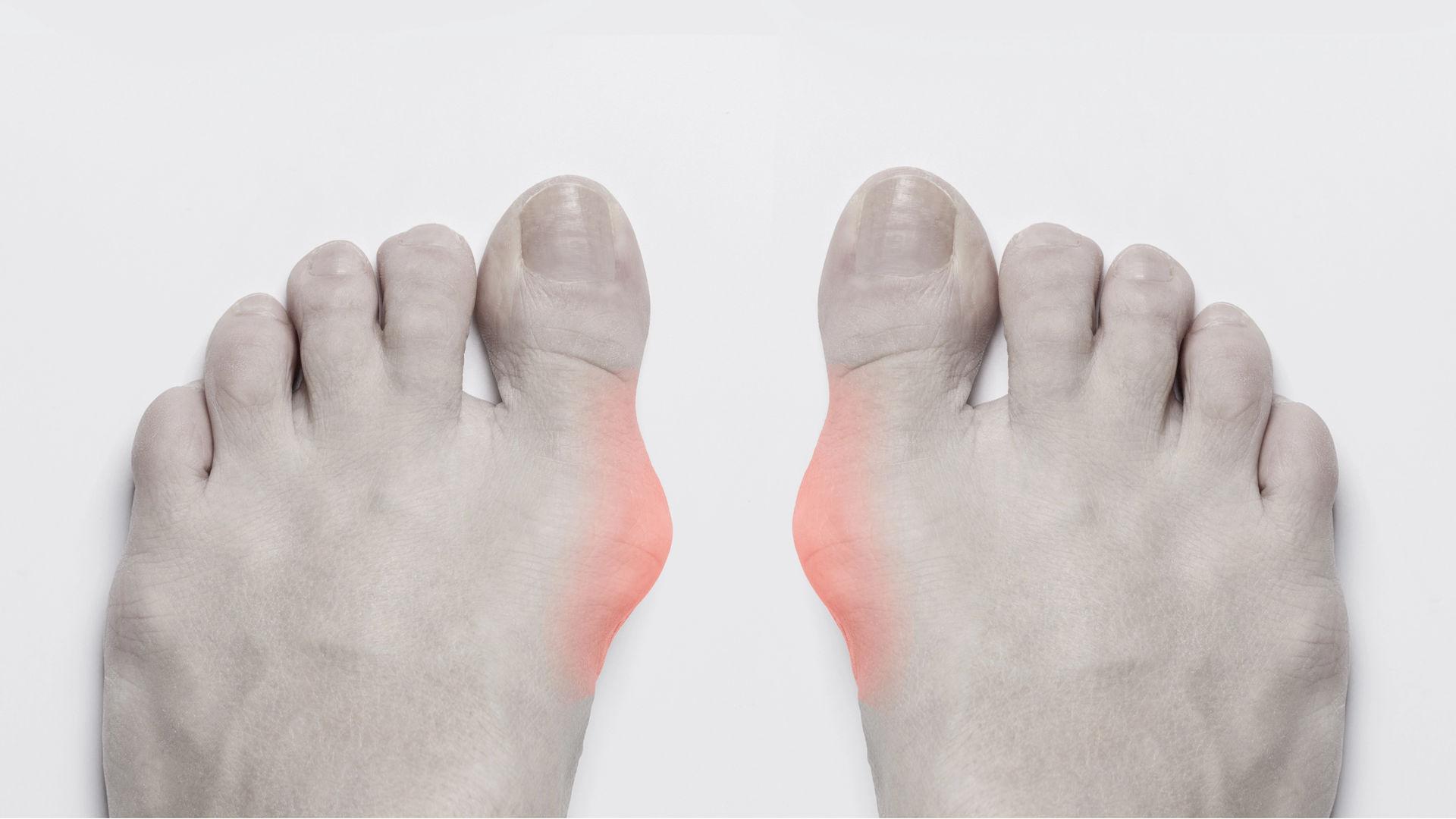 Bunions / hallux valgus