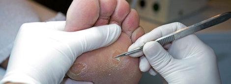Corns and calluses
