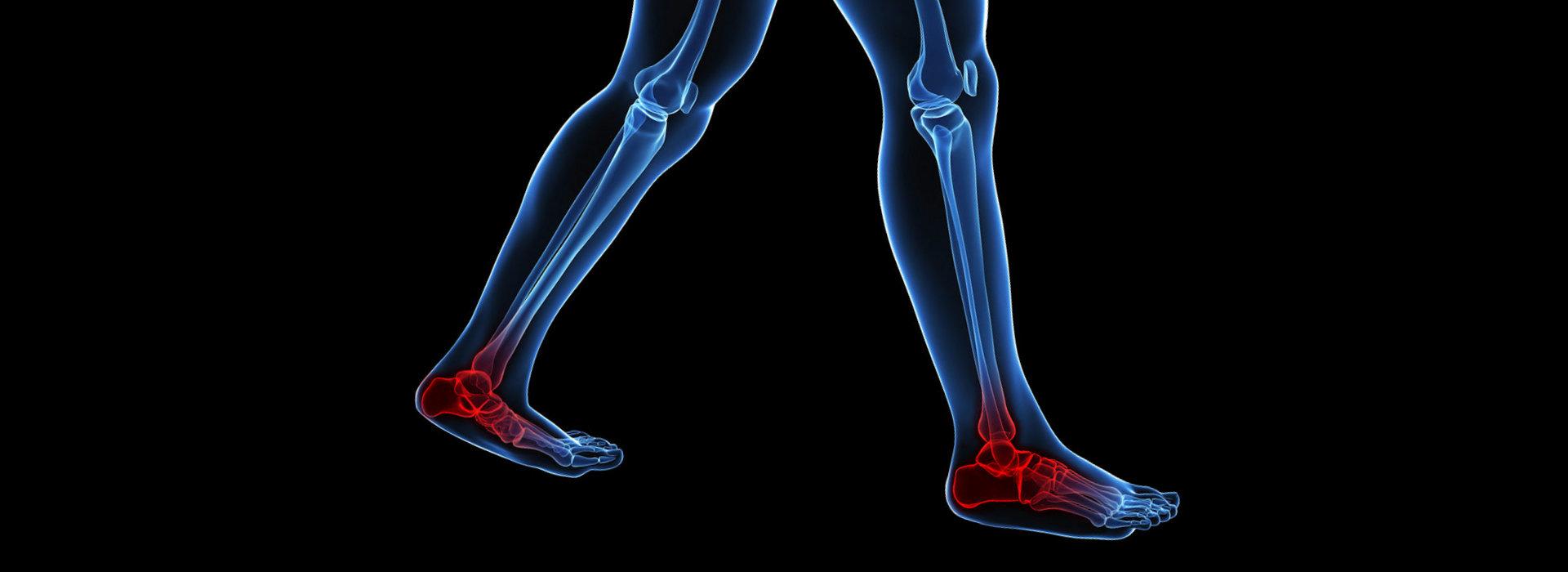 Musculoskeletal foot problems