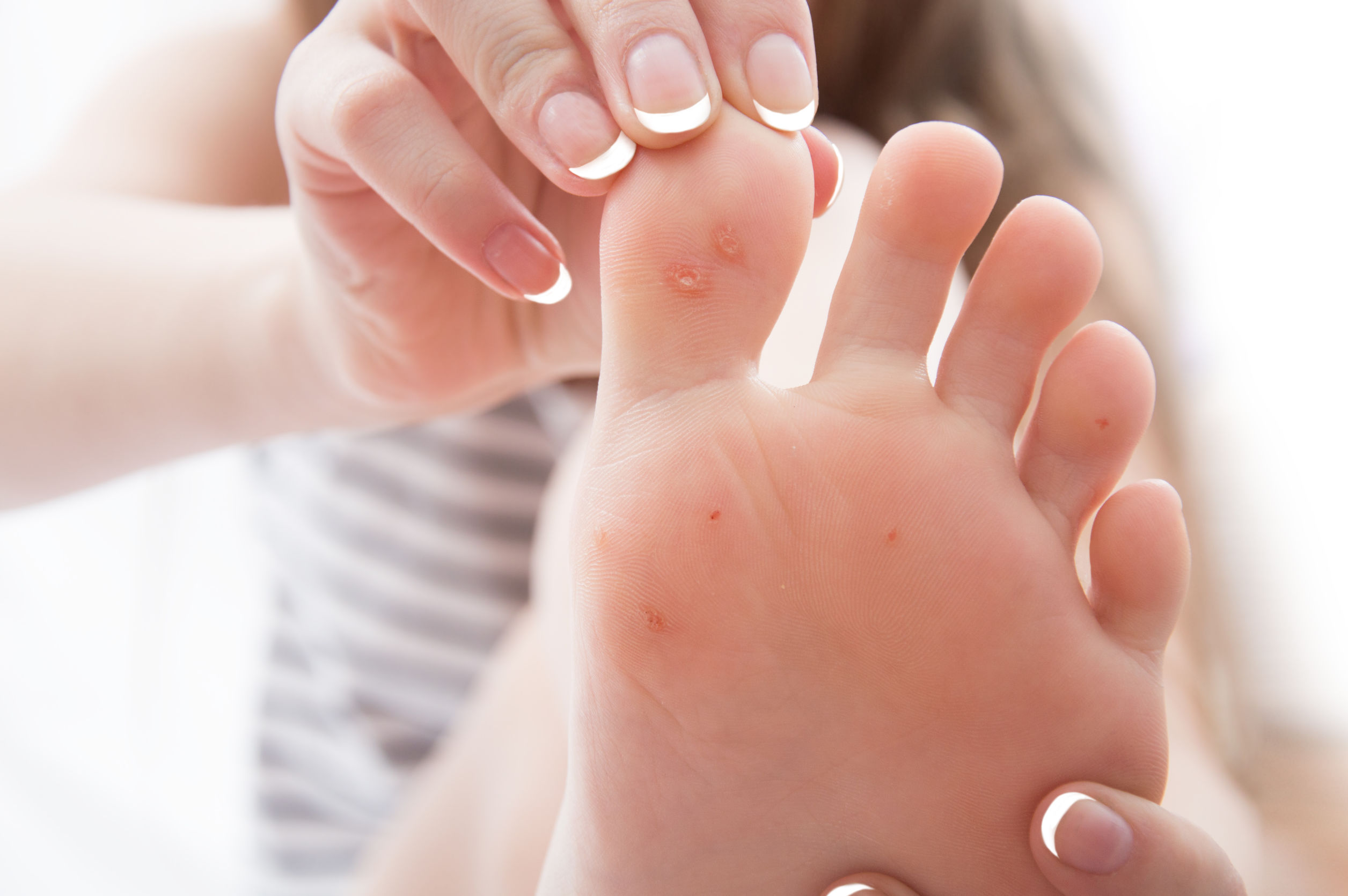 Female foot with problem areas on the skin, dry callus